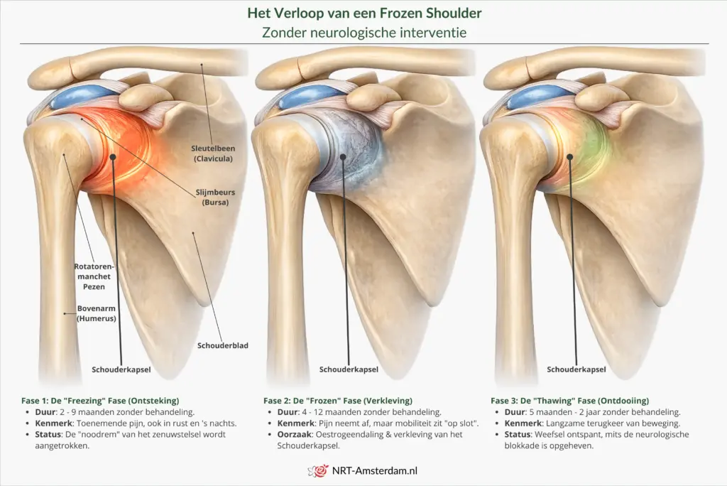 Infographic van de 3 fasen van een Frozen Shoulder: Freezing (bevriezing), Frozen (bevroren) en Thawing (ontdooiing).